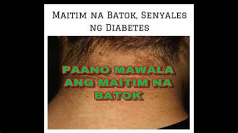 maitim na leeg|Maitim na Leeg, Batok at Siko .